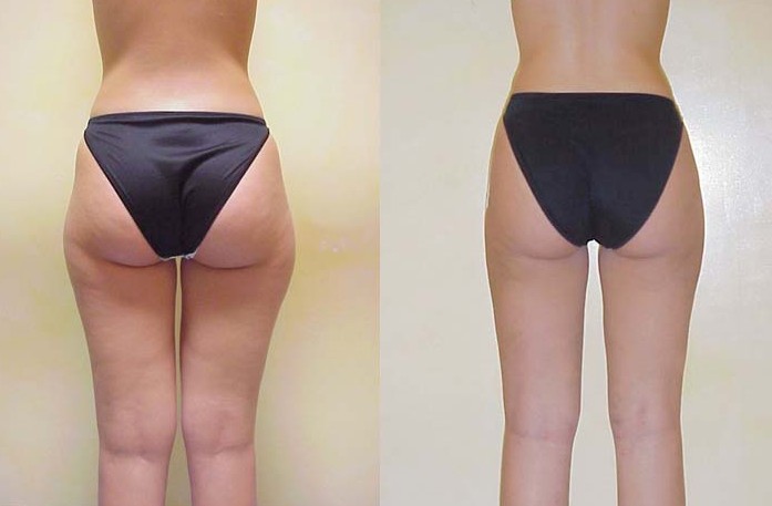 What are the average results for thigh liposuction?