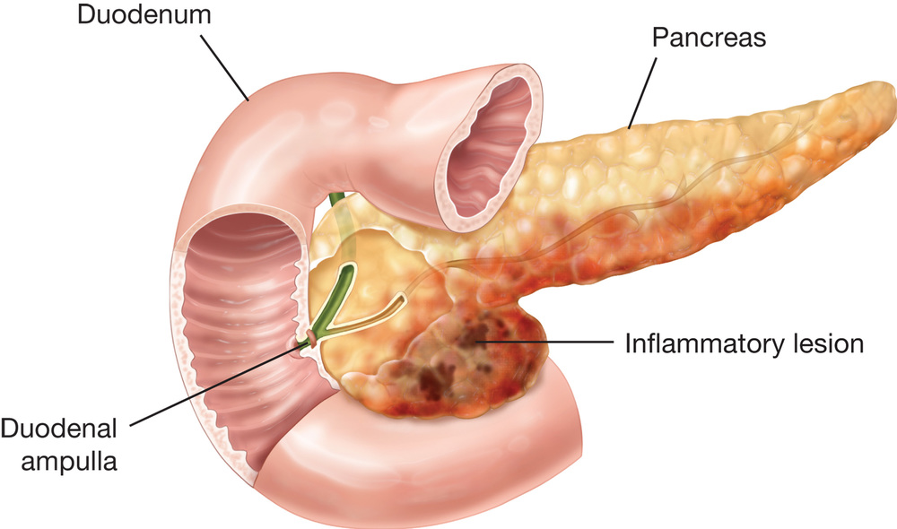Image result for Pancreatitis