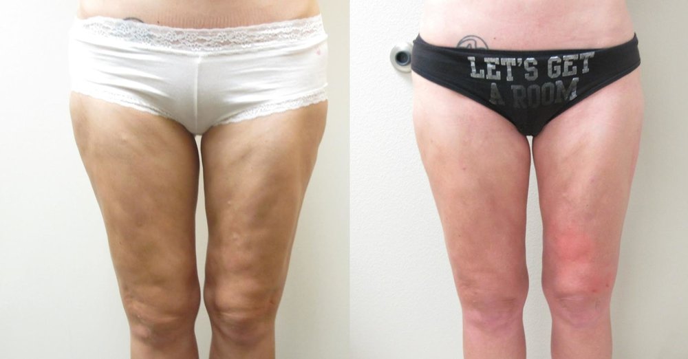 Before & After Correction of Skin Contour Irregularities (Frontal View).  Patient previously had traditional liposuction from another plastic surgeon and she developed skin contour irregularity.  Dr. De La Cruz performed the VASER liposuction of the thighs with fat transfer to correct the contour irregularity.