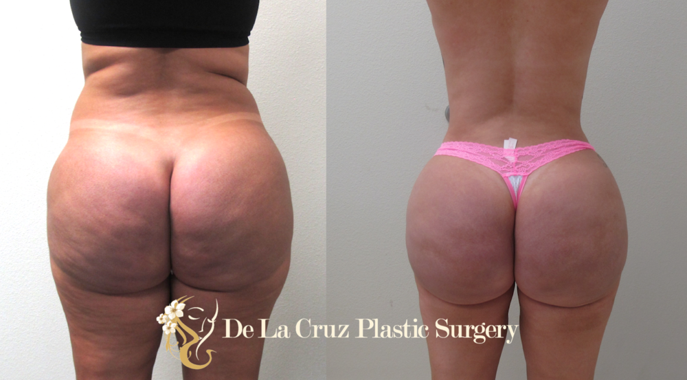 Figure 2:  Hydrogel/Biopolymer removal from the buttocks using the VASER Liposuction with fat transfer to the buttocks to correct the resulting deformity from removal of the biopolymer.  Patient had resolution of a chronic buttock pain after surgery.