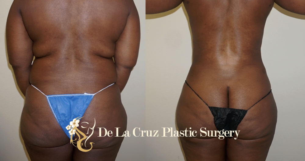 Before & After Photos of VASER Liposuction (6 weeks after surgery) performed by Emmanuel De La Cruz MD, PLLC.