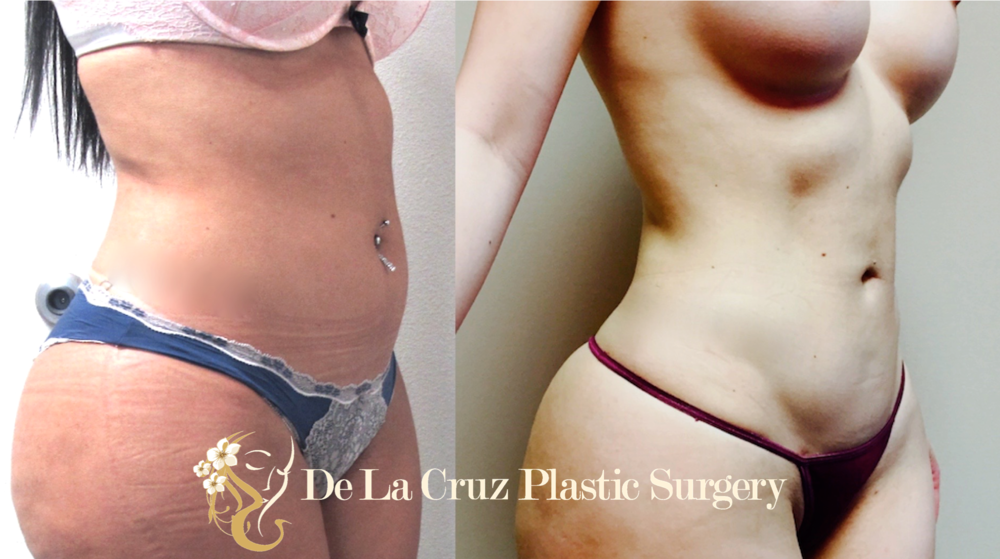 4D VASER Liposuction performed by Dr. Emmanuel De La Cruz of Houston, Texas