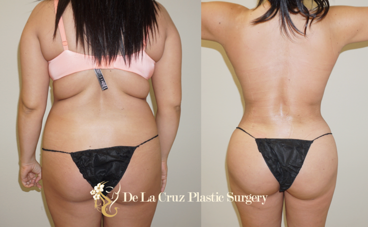 Figure 1: Before & After Photos of 4D VASER Liposuction with Brazilian Buttlift performed by Dr. Emmanuel De La Cruz (8 weeks after surgery)