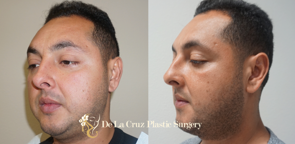 Buccal Fat Removal Before & After Photos (3 months after surgery) performed by Dr. Emmanuel De La Cruz.