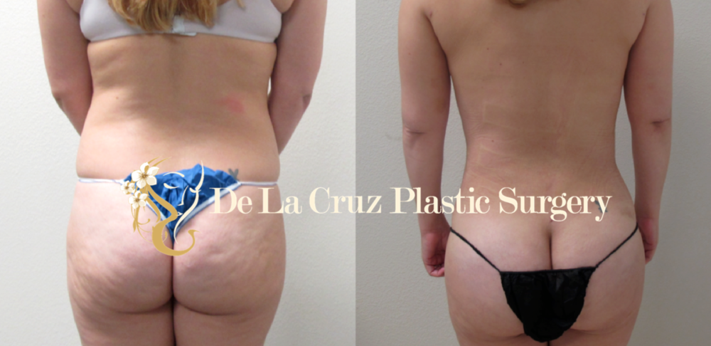 Before & After Photos of VASER Liposuction performed by Dr. Emmanuel De La Cruz.
