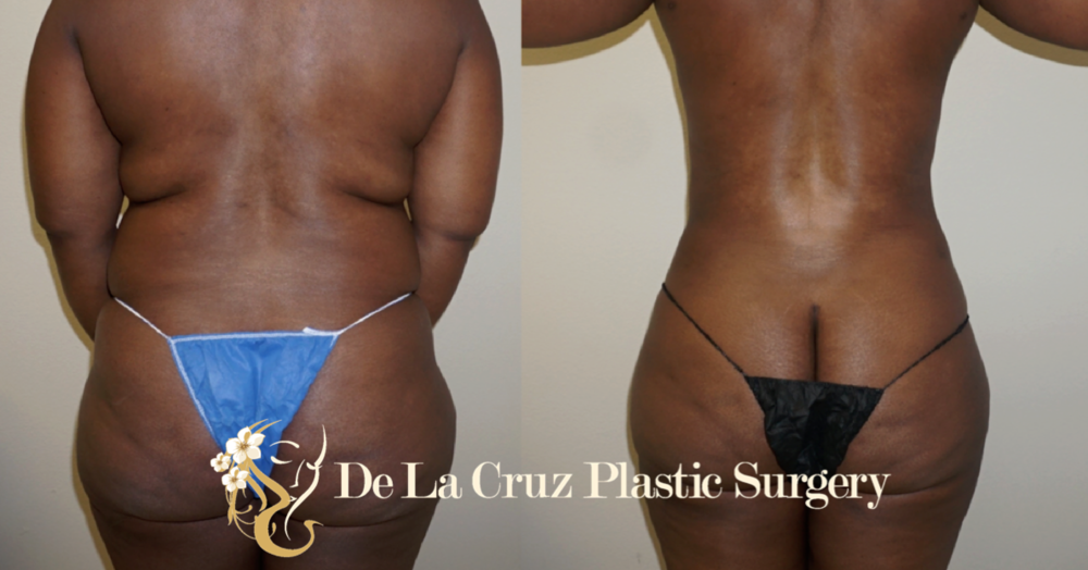 Before and After Photos of Large Volume Liposuction performed by Dr. Emmanuel De La Cruz.