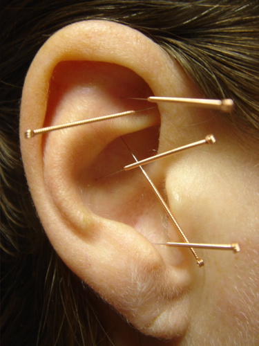 ear-acupuncture-How-to-Stimulate-Your-Vagus-Nerve-for-Better-Mental-Health-brain-vns-ways-treatment-activate-natural-foods-depression-anxiety-stress-heart-rate-variability-yoga-massage-vagal-tone-dysfunction