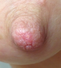 White Spots On My Nipples 109