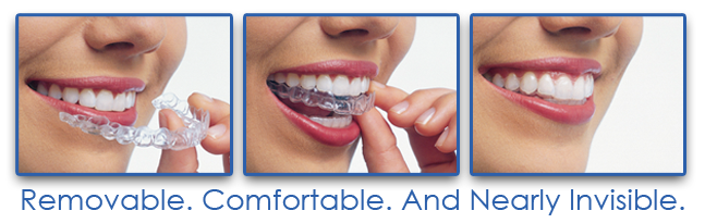 Image of How Invisalign Attaches to Teeth