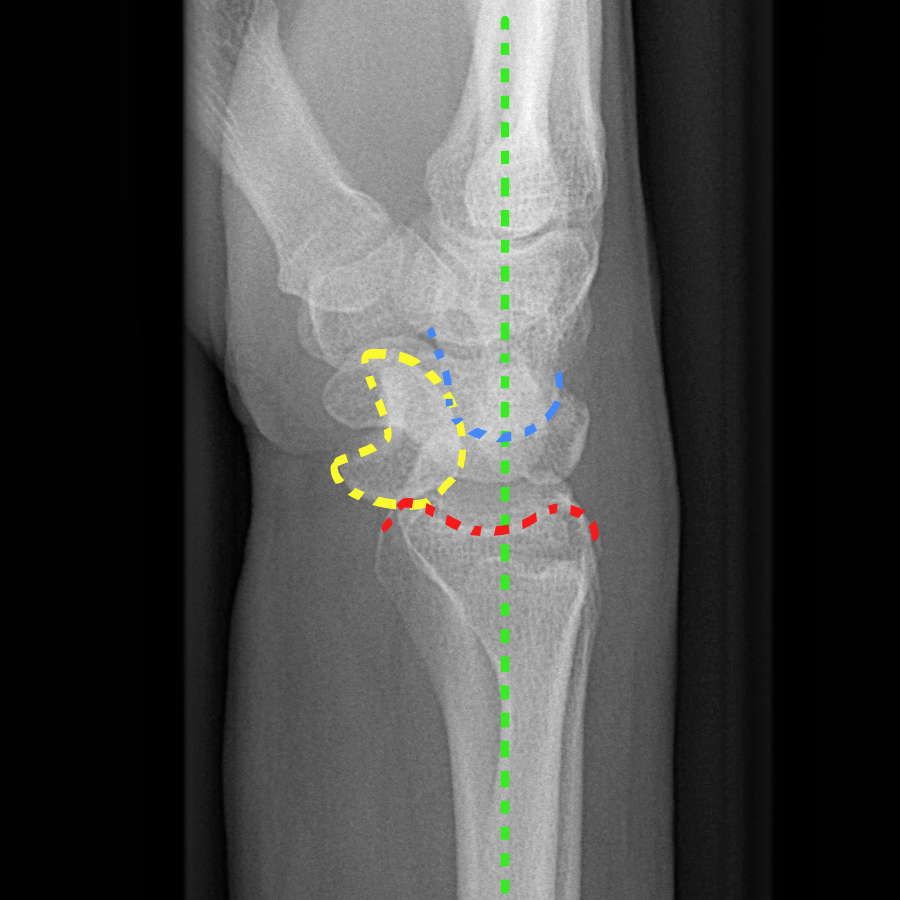 Extra-Caliber (carbon fiber) Radiolucent Tibia/Ankle System