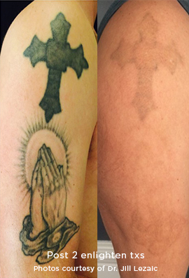 [Image: Enlighten-tattoo-removal-siti-med-spa-8.jpg]