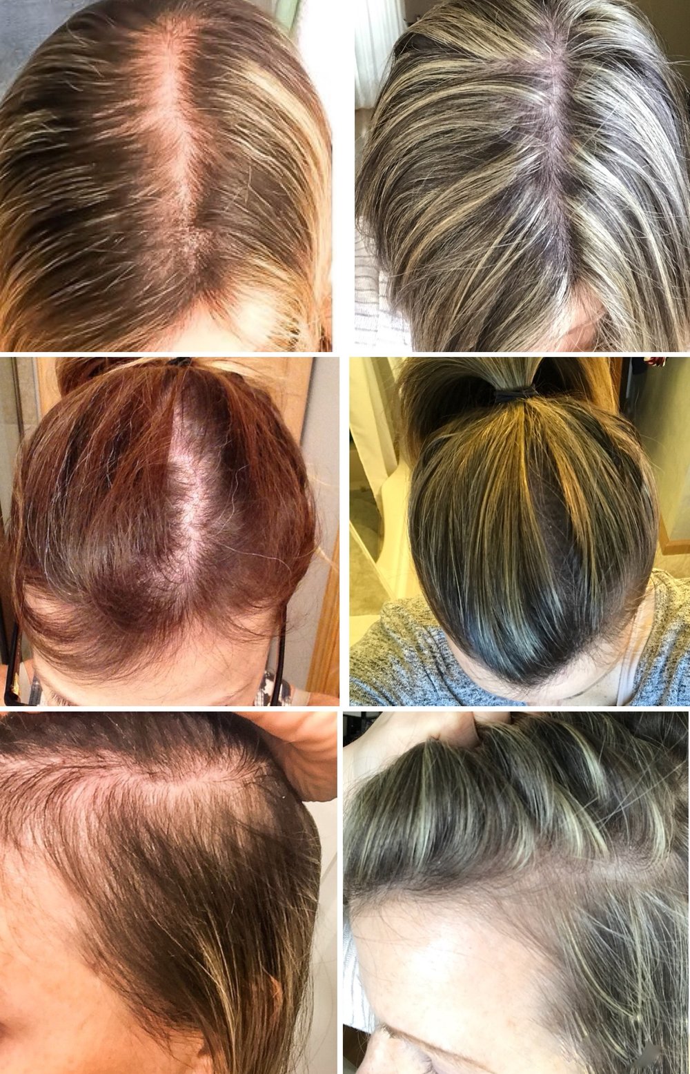 Women And Hair Loss Causes Solutions And Support First Thyme Mom