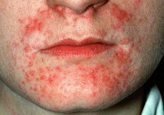 swelling of rosacea Treating facial