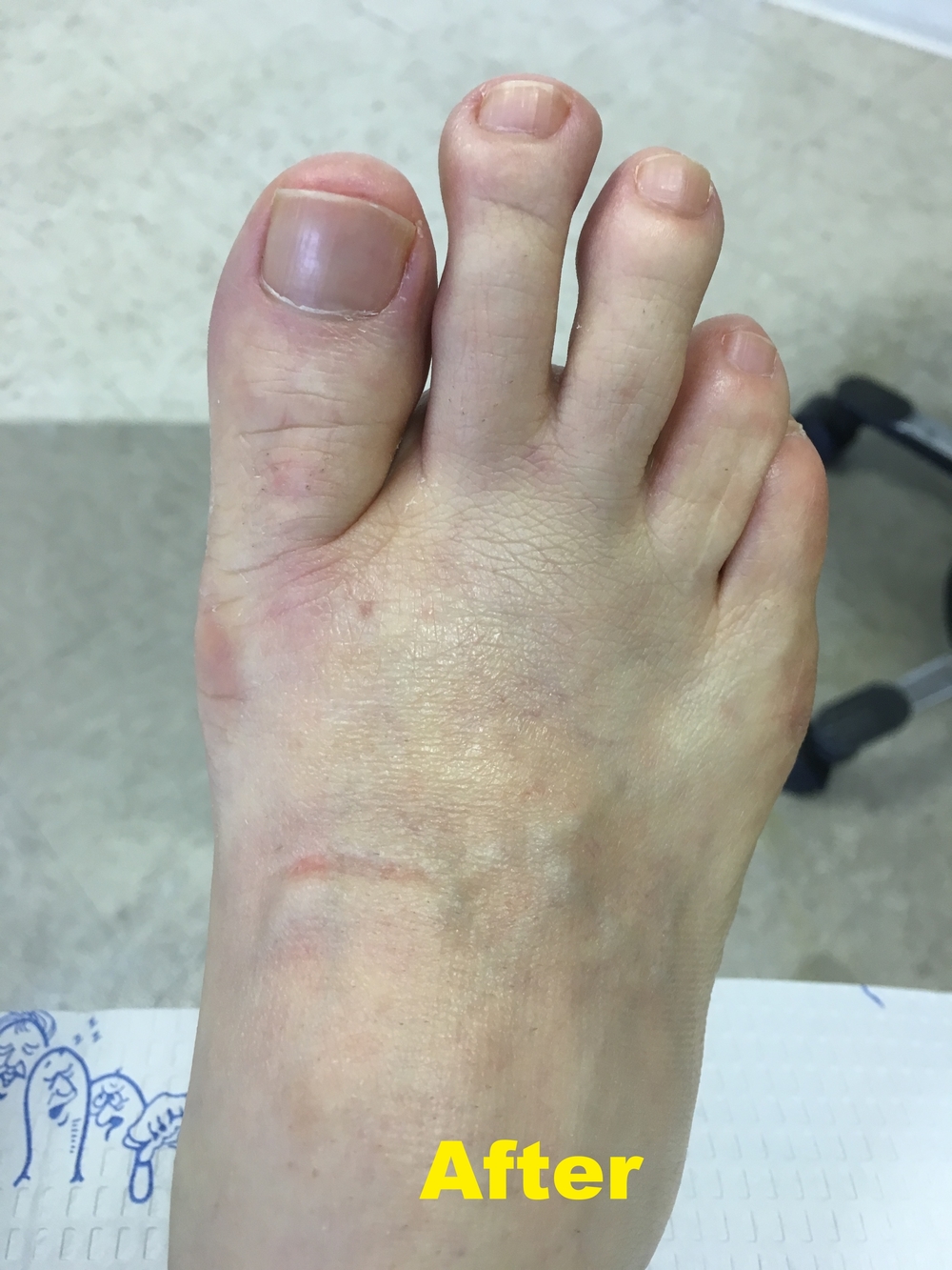 Bunions — United Foot & Ankle Surgeons