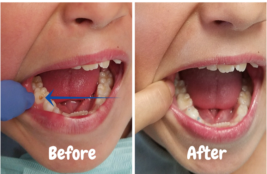 Dental Fillings / Cavity Treatment — Shanna Chirco DDS