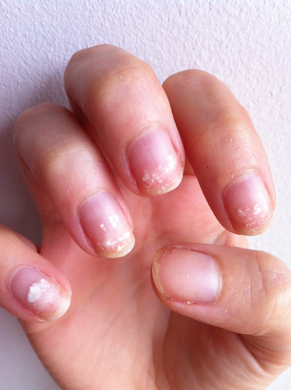 15 Damaged Nails After Acrylics