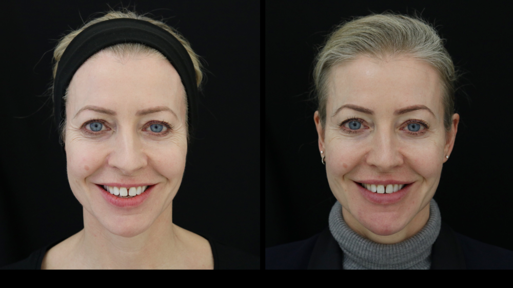 Filler in my temples and outer cheeks helps support the eyebrows and mid-face&nbsp;