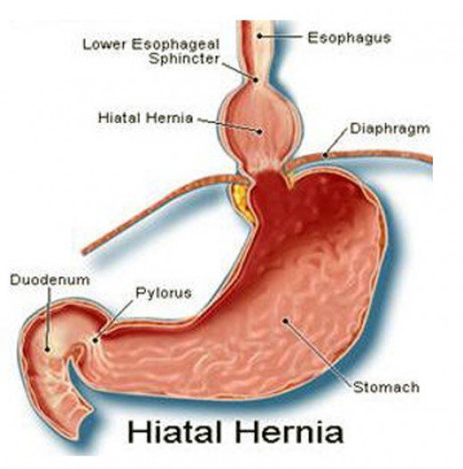 Hernia hiatala provoaca anemie