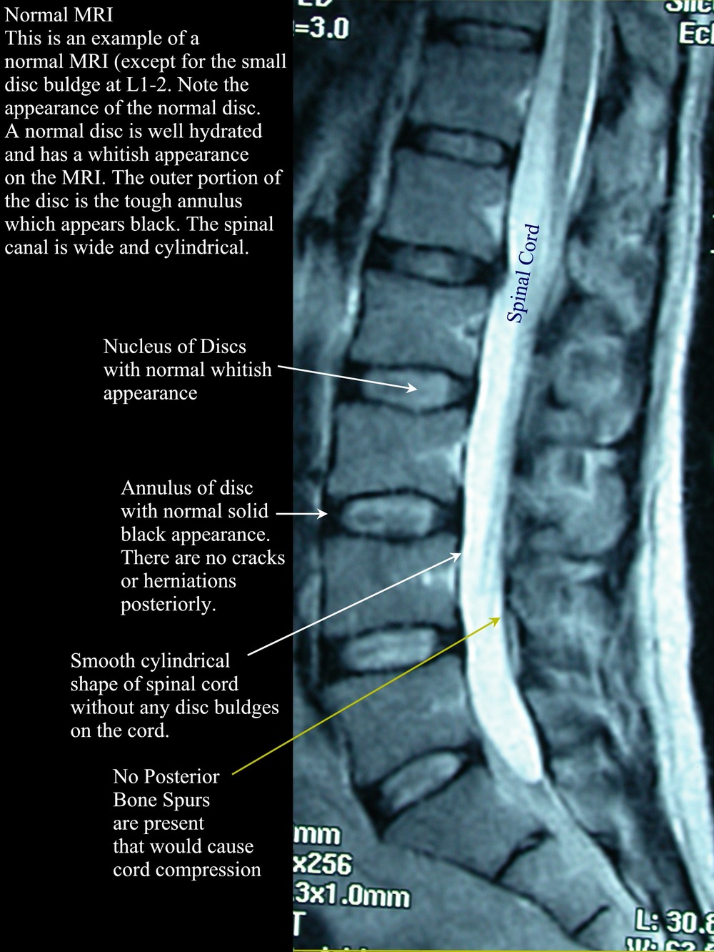 Imaging And The Lumbar Spine, What Does It Tell Us? — Accelerated