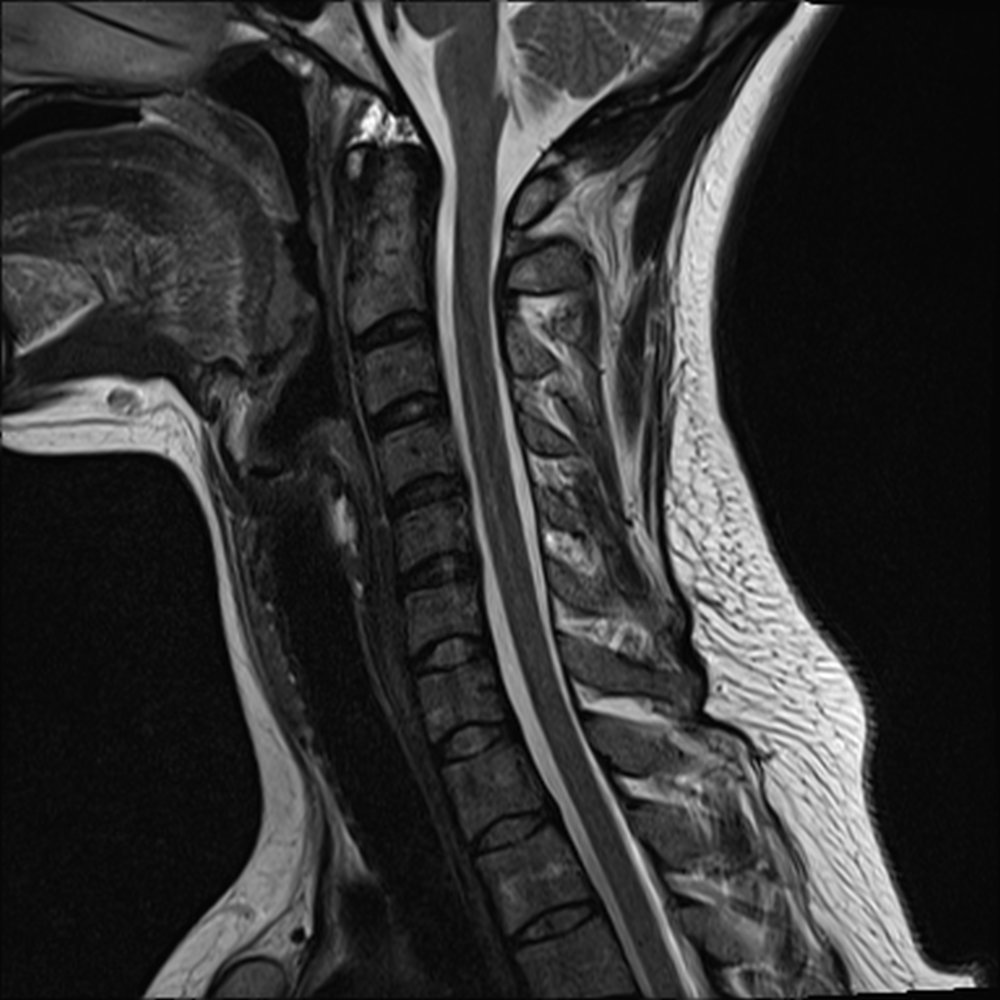 Cervical Spine Mri Spinal Cord Injury