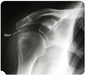 Shoulder impingement — Park Clinic Orthopaedics