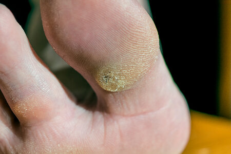 Your Podiatrist Can Treat Your Plantar Warts — Podiatry Group of Annapolis, P.A.
