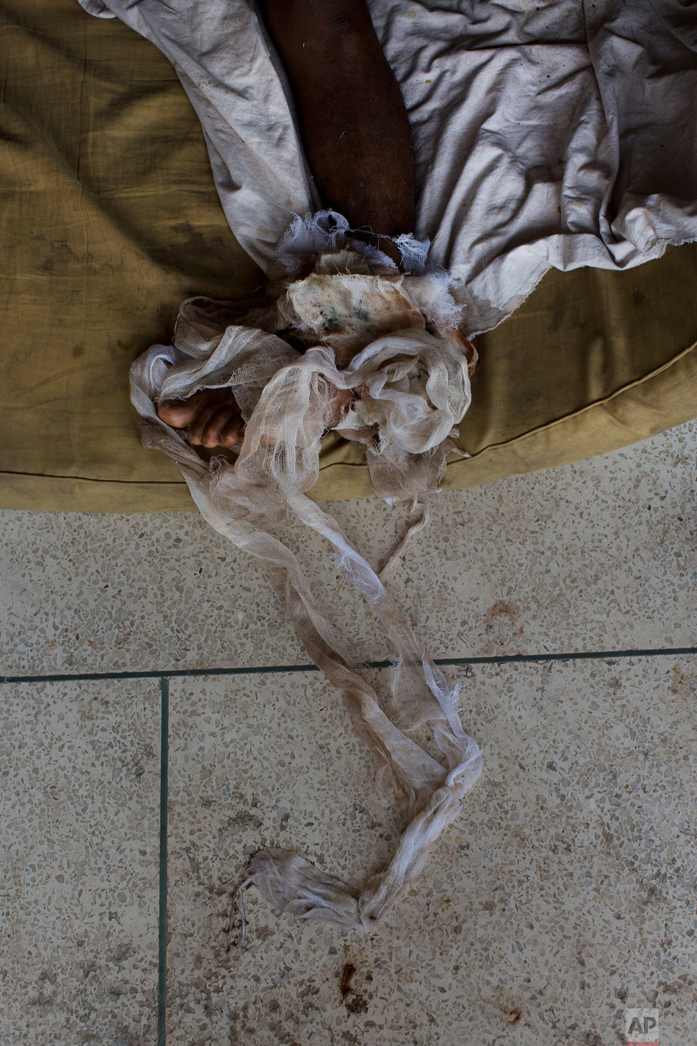 EDS NOTE GRAPHIC CONTENT - Rohingya men Abdul Karim lies on the floor at Sadar Hospital in Cox's Bazar, Bangladesh, Sunday, Sept. 10, 2017. Karim sustained severely bullet injuries on his left foot and chest when Myanmar monks and soldiers attacked his village. (AP Photo/Bernat Armangue)
