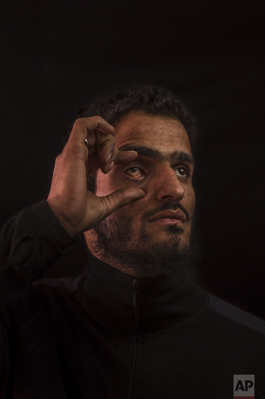 In this Nov. 29, 2016 photo, Aamir Ashraf Hajam, 25, poses for a portrait in a village near Baramulla, Indian-controlled Kashmir. Aamir lost his right eye six years ago after India security forces used a shotgun loaded with metal pellets. Health officials say that in the past five months more than 6,000 people, mostly young men, have been injured by shotgun pellets, including hundreds blinded in one or both eyes. (AP Photo/Bernat Armangue)