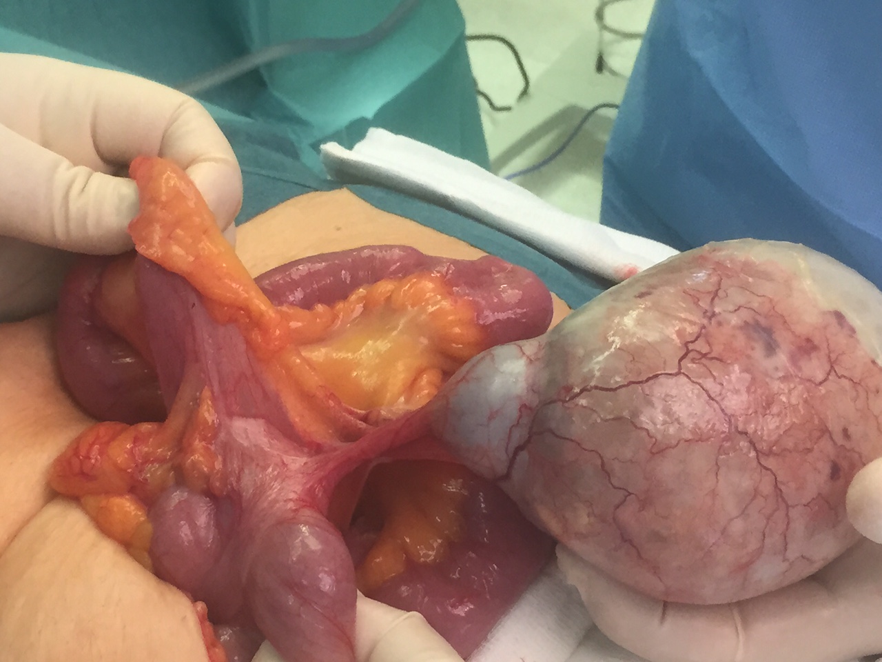 peritoneal cancer from appendix papilom aproximativ
