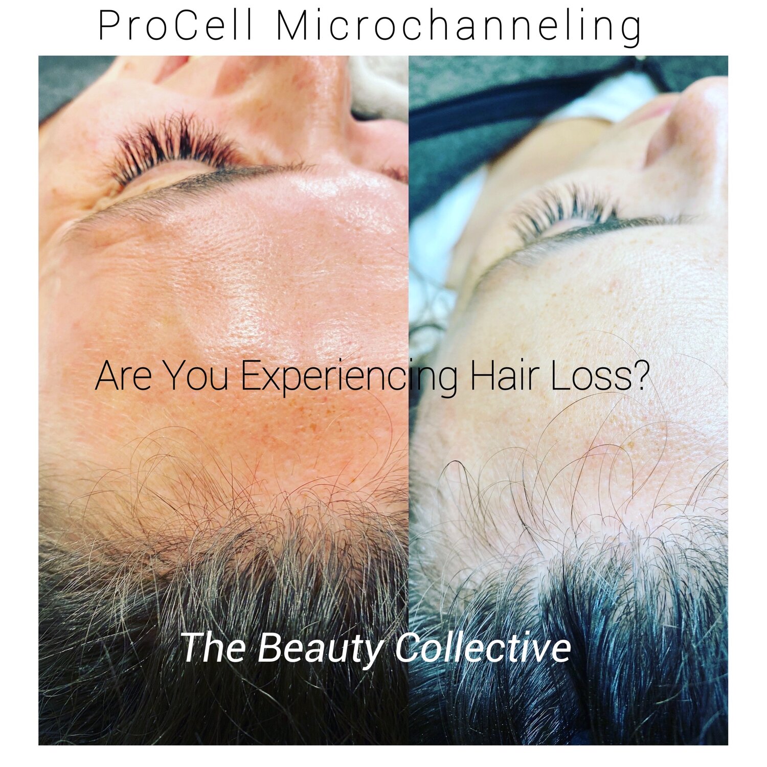 Portland, OR | What Is ProCell Microchanneling? — The Beauty Collective PDX | Lash Extensions, Permanent Makeup and More