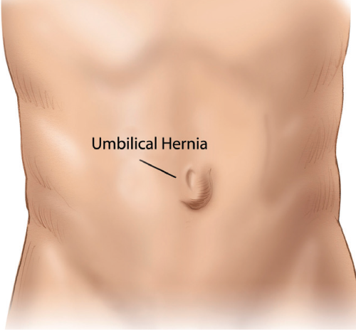 Umbilical Hernia In Adult 115