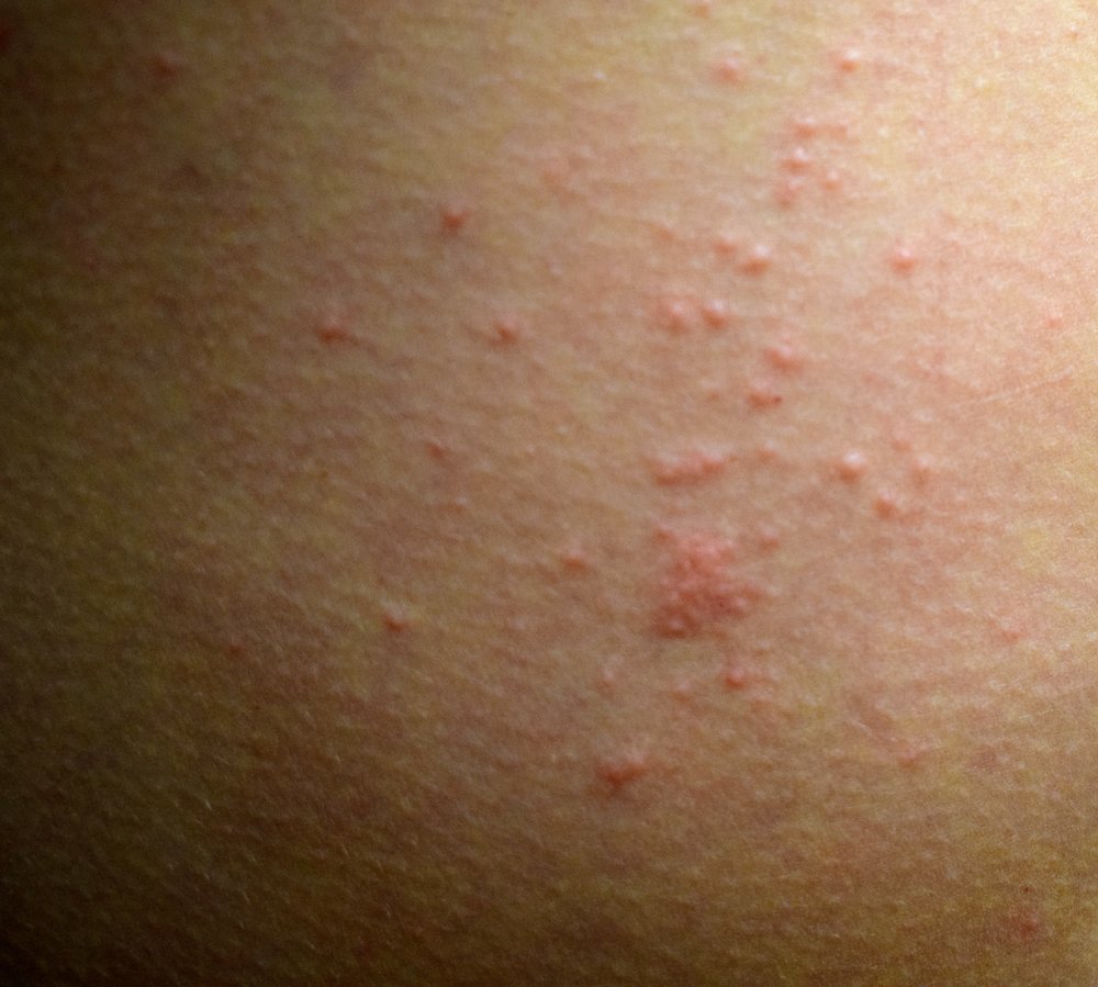 it-happens-dealing-with-scabies-savvy-dispatches