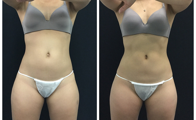 Coolsculpting Before After 15 Jpg