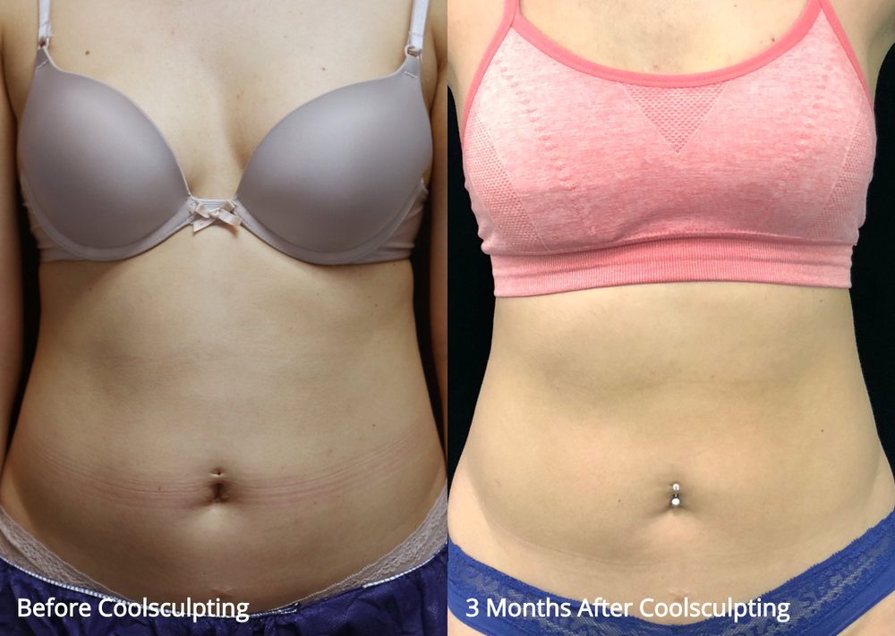 Coolsculpting Before After 18 Jpg