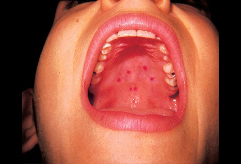 How Long Does Strep Throat Last in the Elderly and Adults?