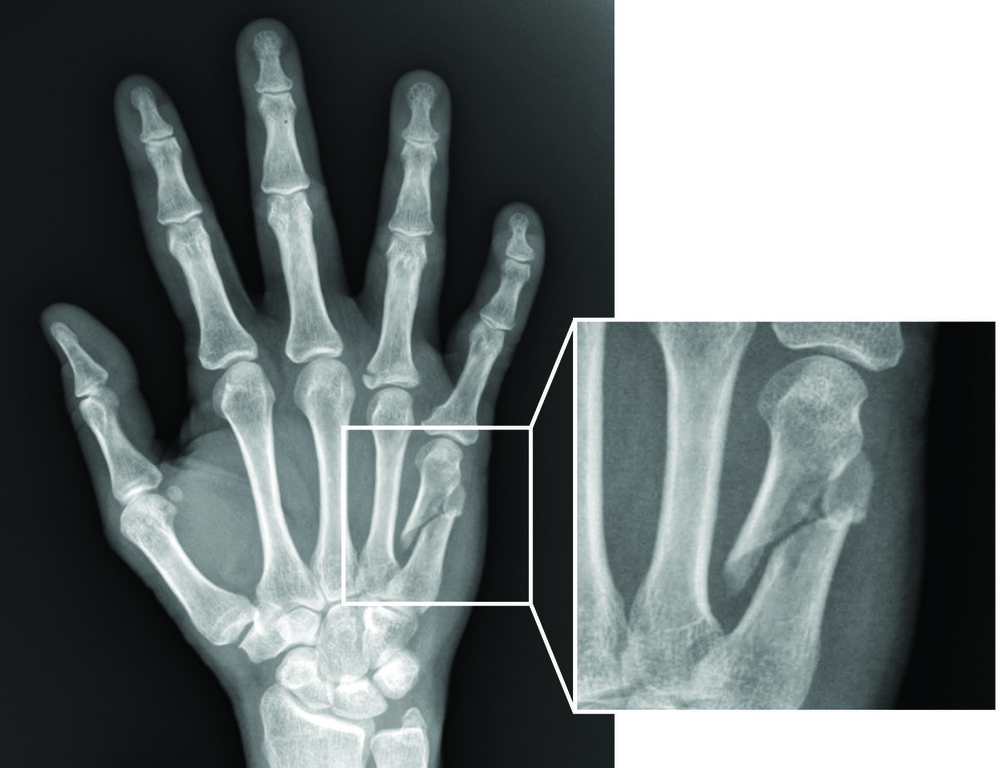 Hand Fracture Clinic