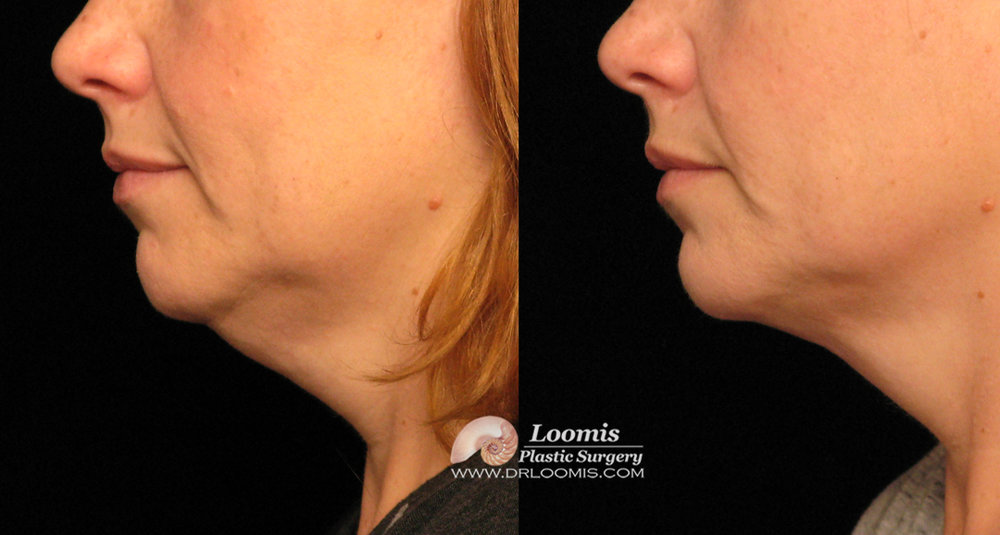 Neck Fat Removal 31