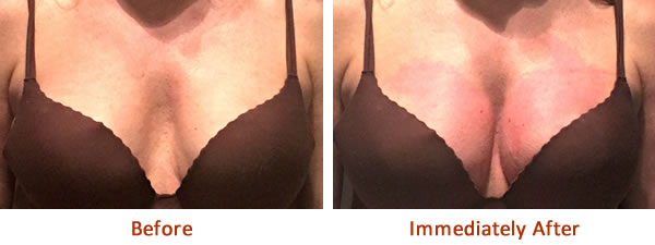 Image result for breast lift before and after 