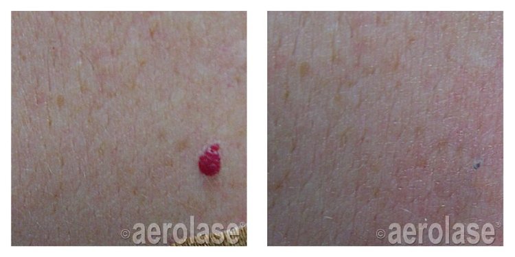 Copy of Laser for Angiomas