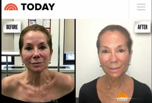 4 Treatments and only 4 weeks apart with our Aerolase NEO laser!