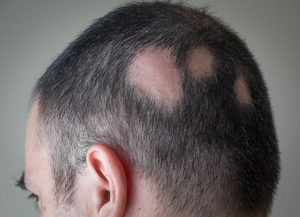 Image result for alopecia areata
