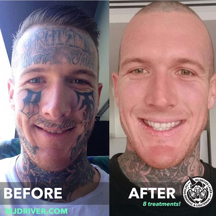 Color Tattoo Removal Before And After - Pin on Market Reports / Your skin color might make removal difficult.