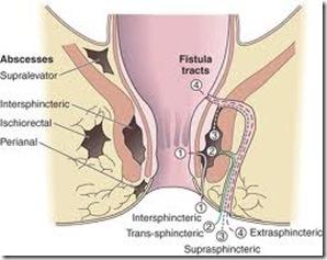 anal fistula of Healing