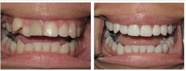 invisalign before after