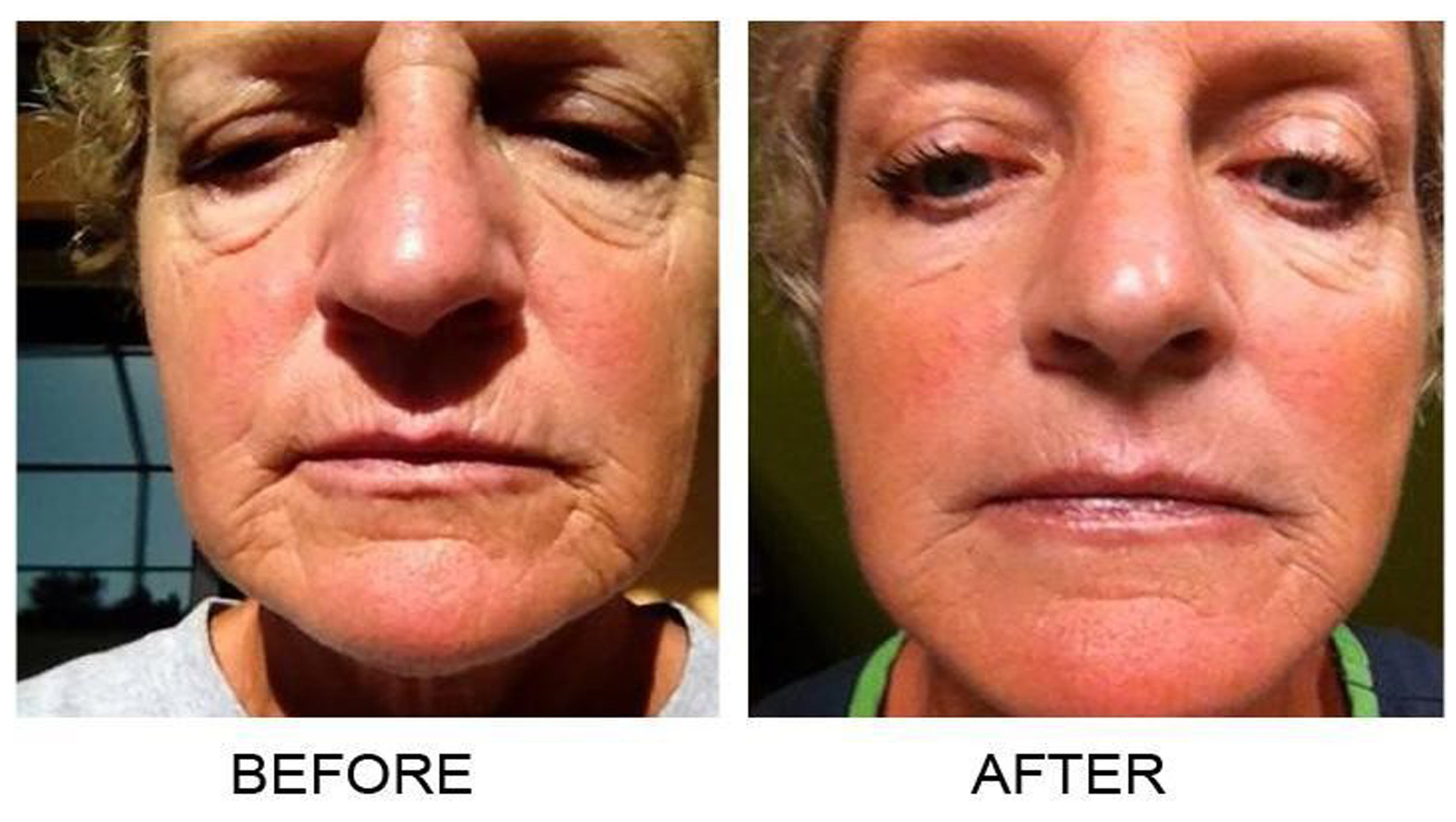  Betty Joe's results after 12 sessions of microcurrent. 
