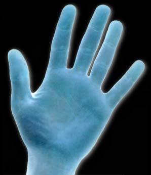 hyperhydrosis of the hands