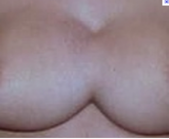 "Symmastia is usually a result of over-dissection of the tissues in the cleavage area. This over-dissection is sometimes done intentionally in hopes of creating or increasing cleavage - other times, its unintentional. Symmastia is commonly referred to as 'breadloafing', or 'kissing implants', or 'uniboob'. With this condition, the implants actually meet in the middle of the chest, giving the appearance of one breast, instead of two."
