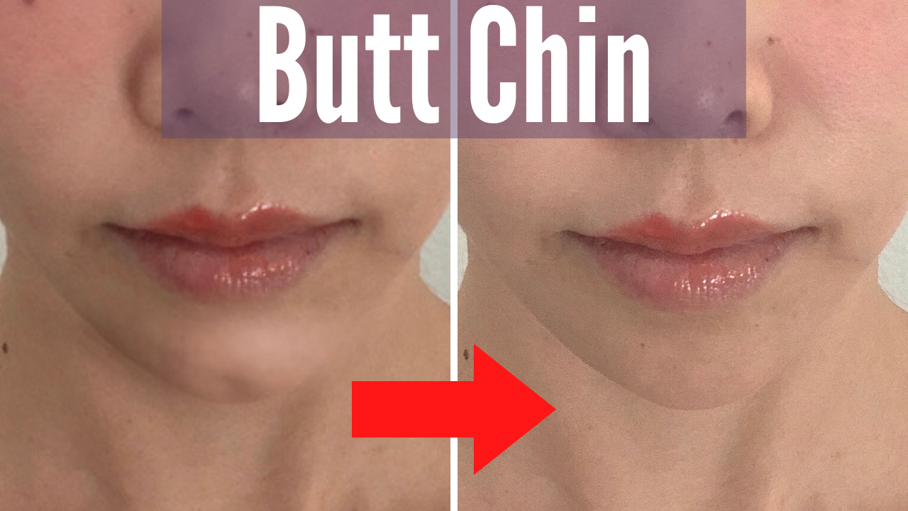 how to get a cleft chin naturally