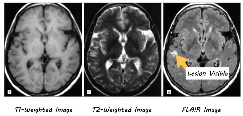 Neuroimaging as a Tool for Diagnosing and Tracking Multiple Sclerosis ...