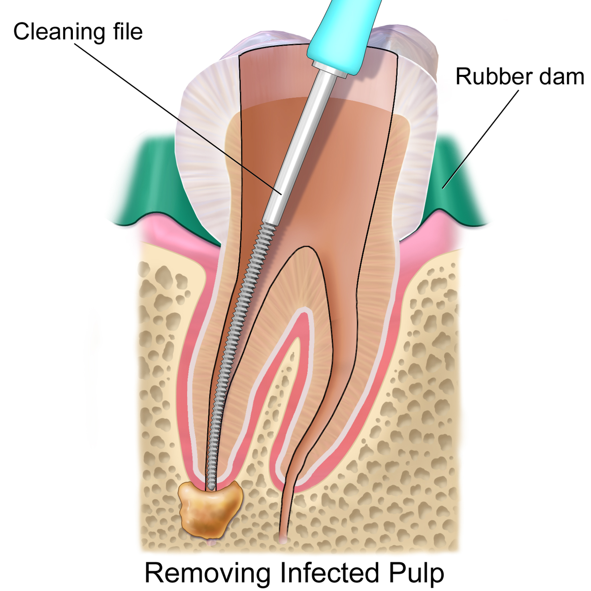 Ask the Dentist: A Helpful Guide to Root Canal Treatment | Capstone Dental